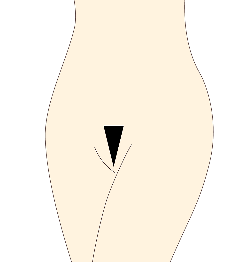 BRAZILIAN TRIANGLE Bei dieser Form des Intimwaxings, wird eine geometrisch exakte Form wird auf dem Venushügel belassen darüber hinaus wird die Intimzone gewachst.
